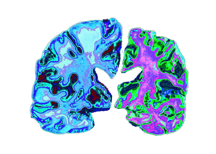 A model of the human brain shows the devastating impact of Alzheimer’s disease.